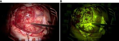 Fluorescein-guided surgery for high-grade glioma resection: a five-year-long retrospective study at our institute